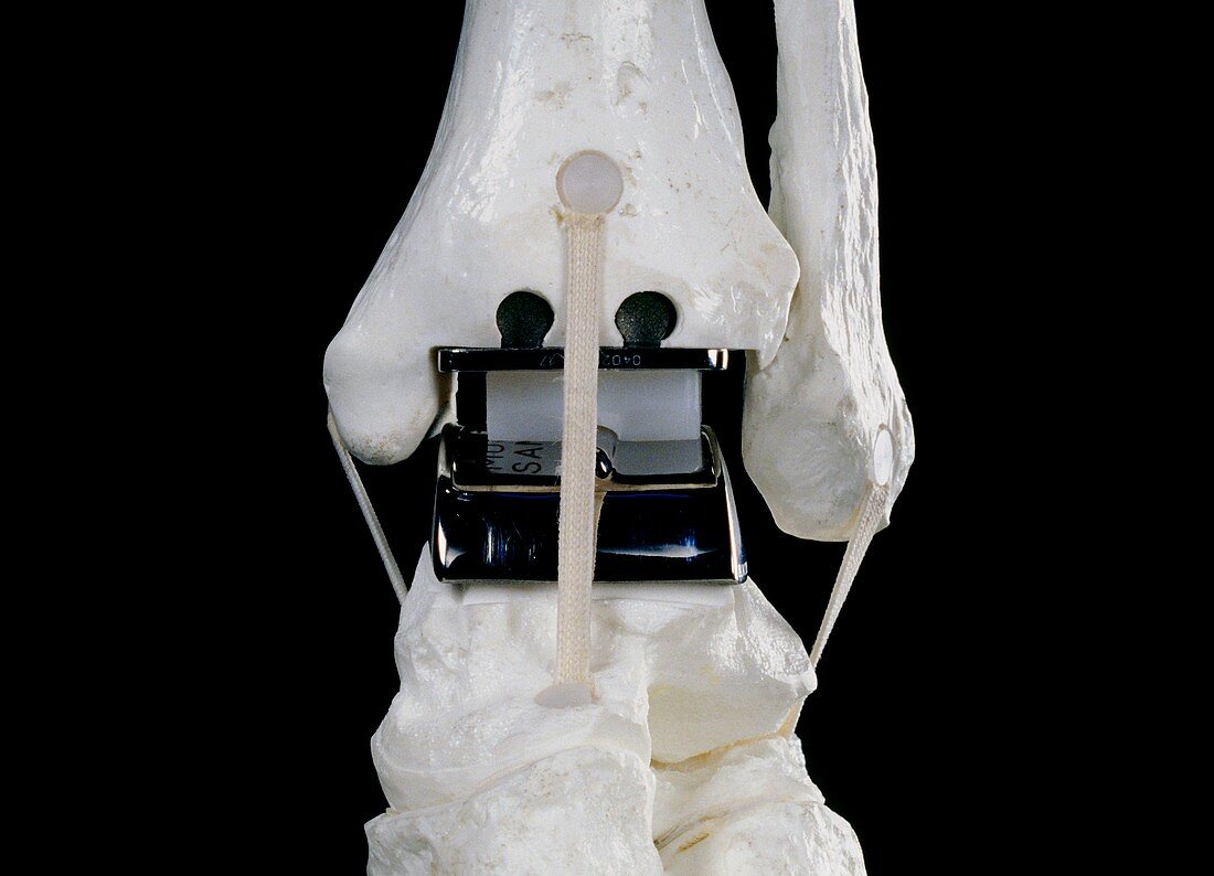Replacement ankle joint