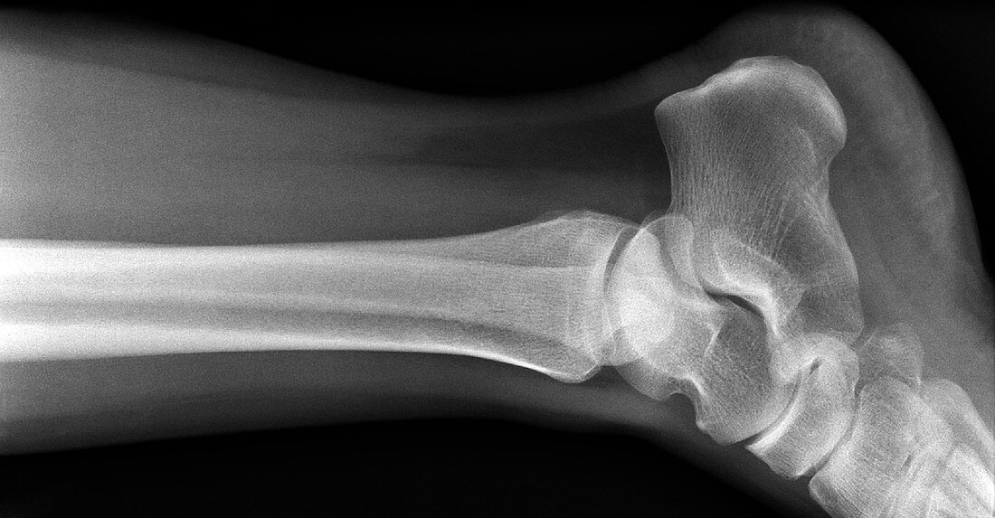 Ankle joint,X-ray