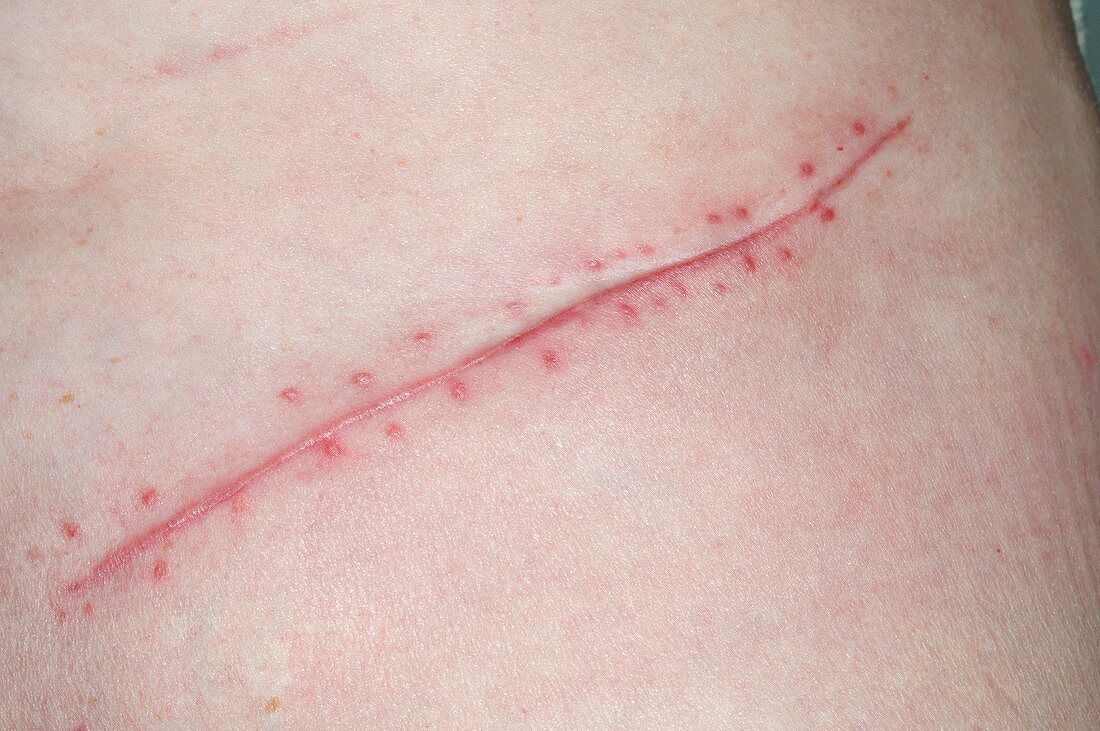 Scar from kidney removal