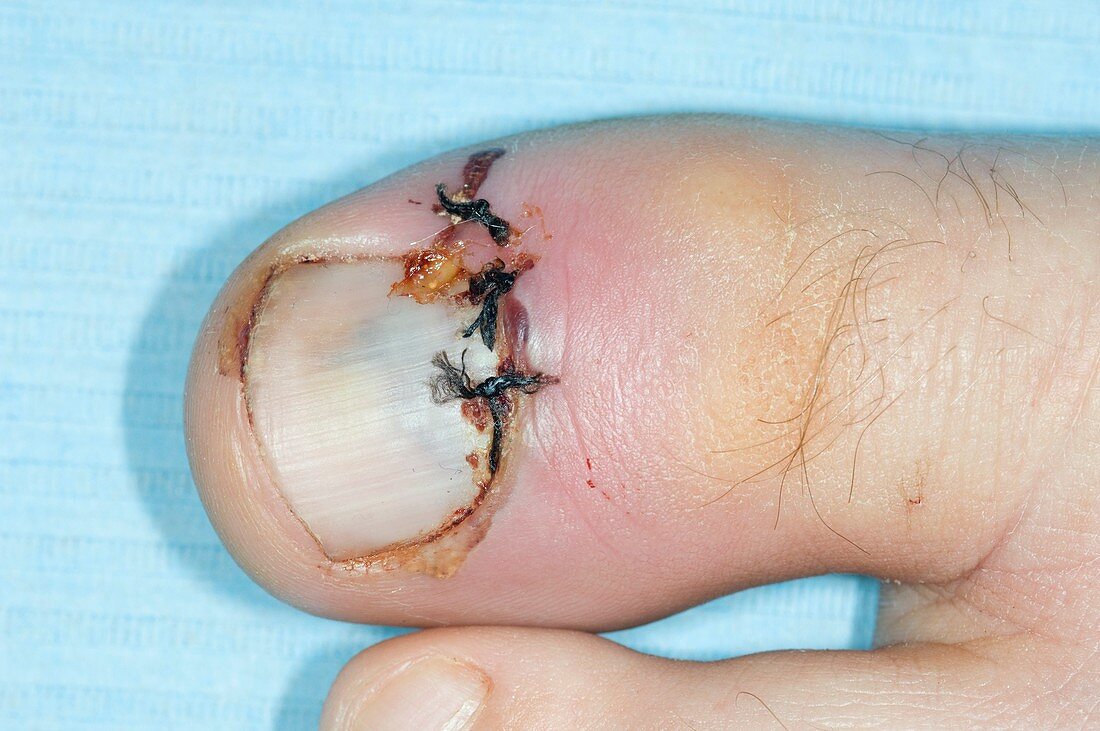 Compound fracture of toe