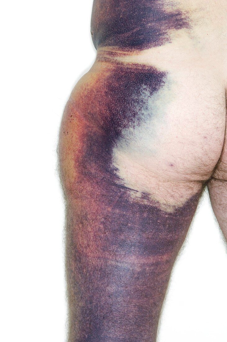 Bruising after a cycling injury