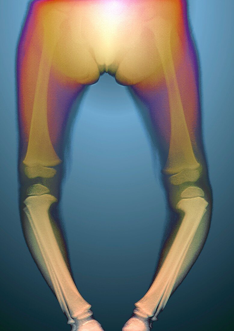 Tibia vara in an infant,X-ray