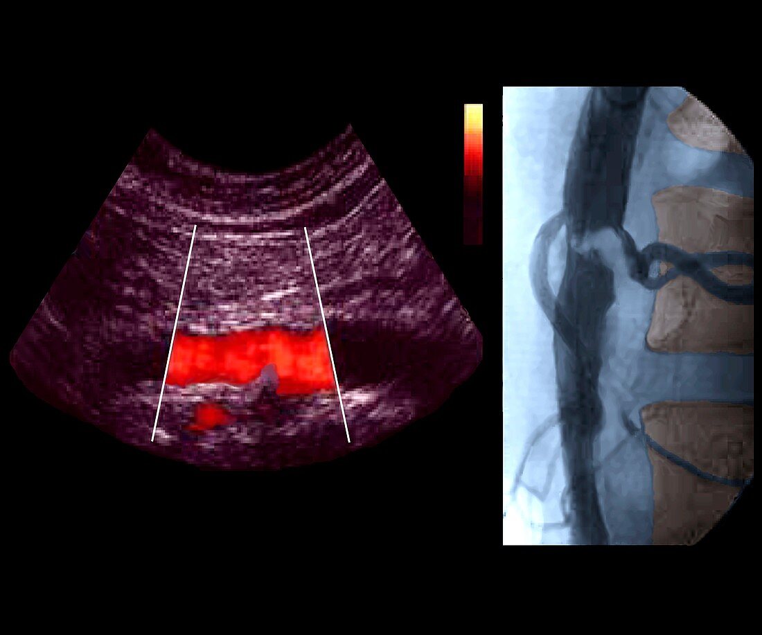 Stenosis in abdominal aorta,ultrasound