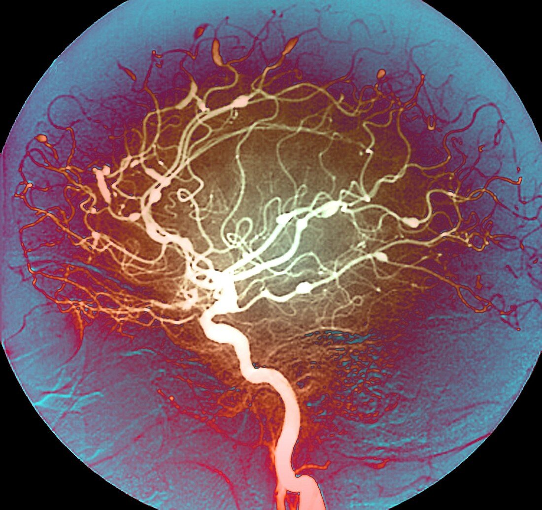 Cerebral aneurysms in Lupus,Angiogram
