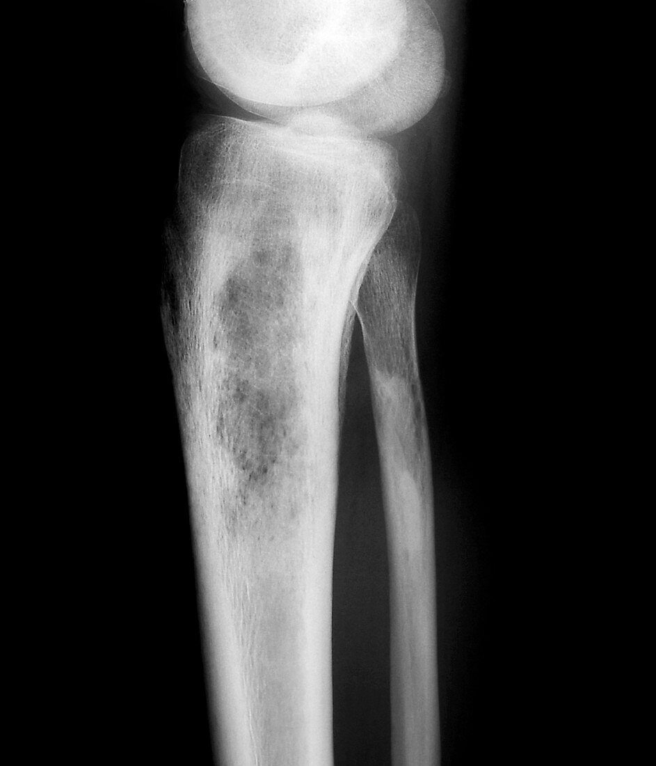 Bacterial bone infection,X-ray