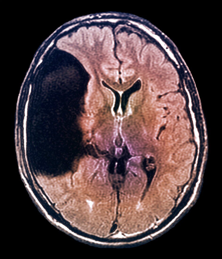 Arachnoid cyst in the brain,MRI scan