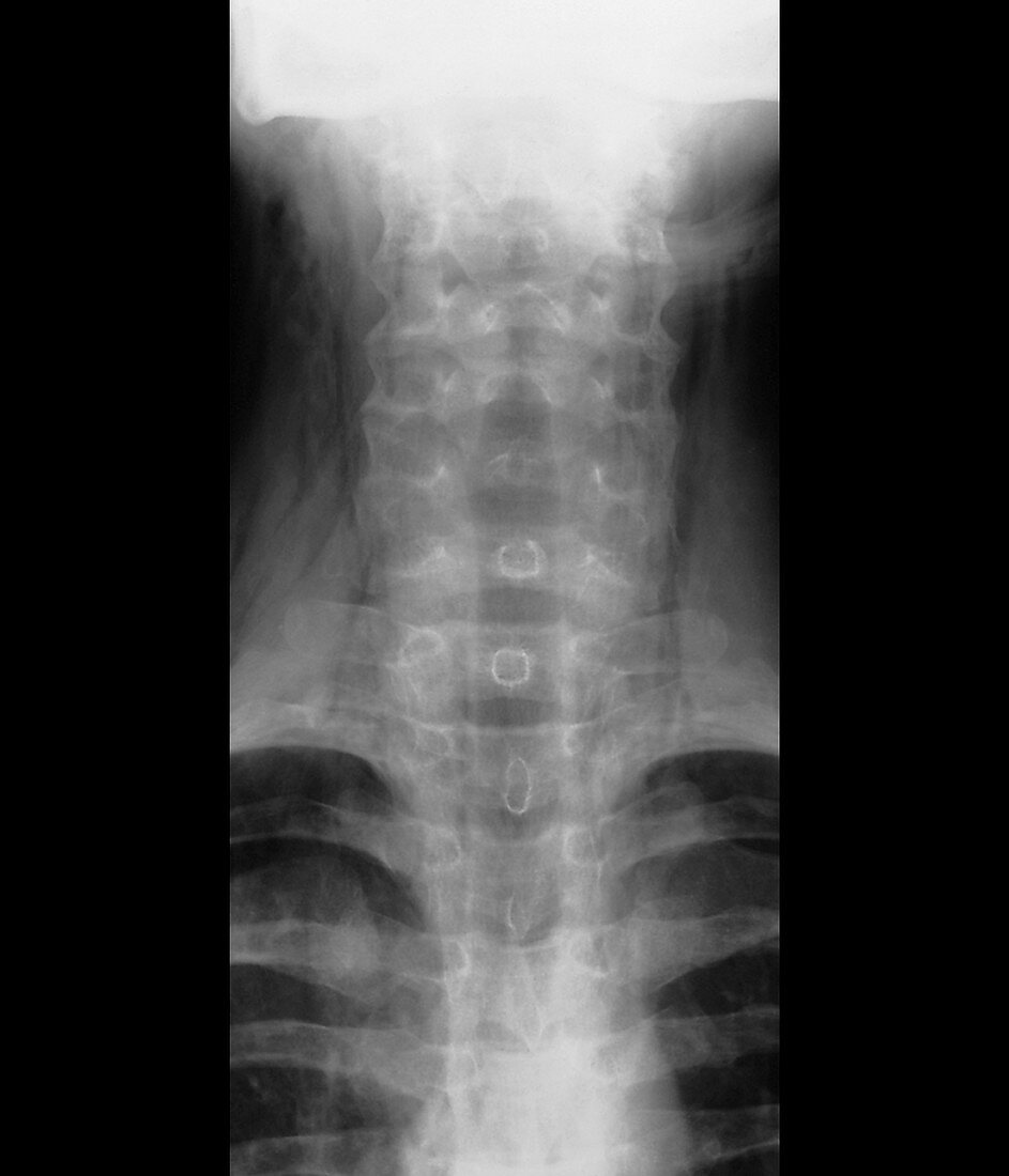 Subcutaneous emphysema,X-ray