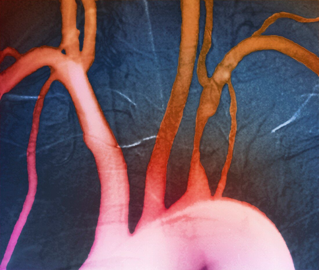 Stenosis of heart artery,angiogram