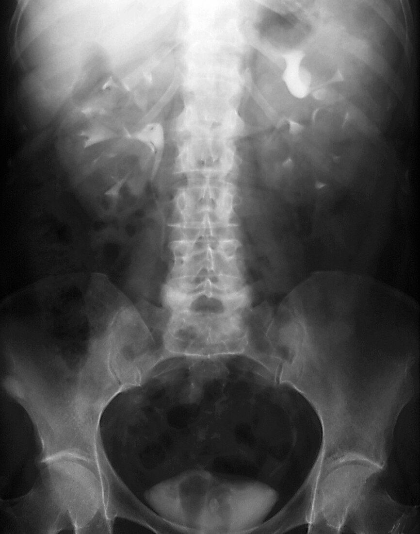 Polycystic kidney disease,urogram X-ray