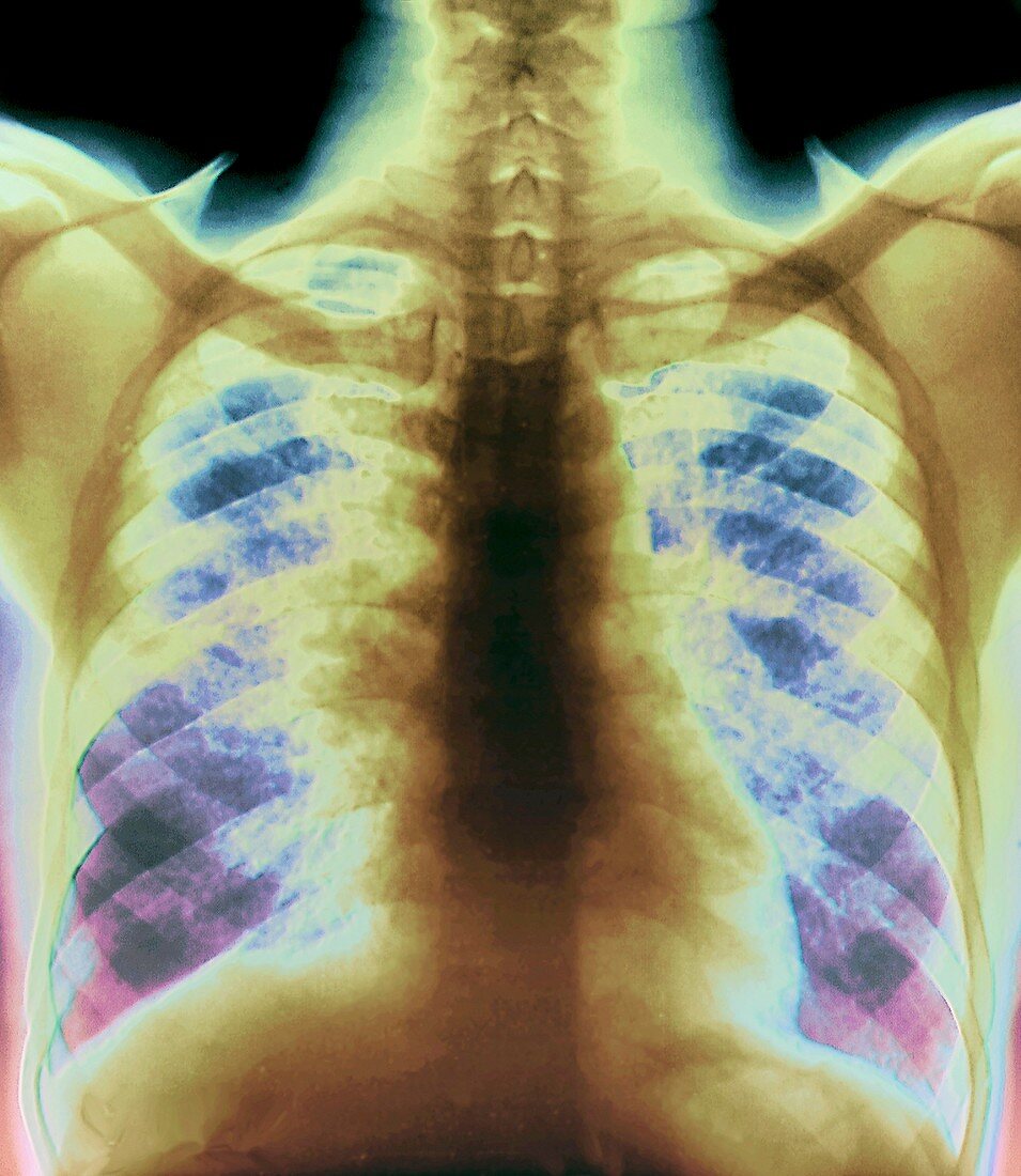 Sarcoidosis of the lungs,X-ray