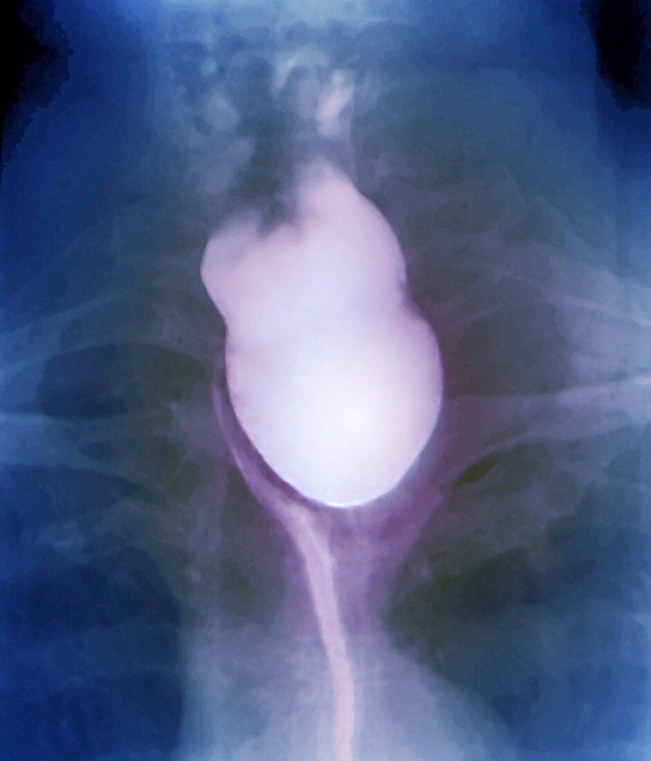 Diverticulum in the oesophagus,X-ray