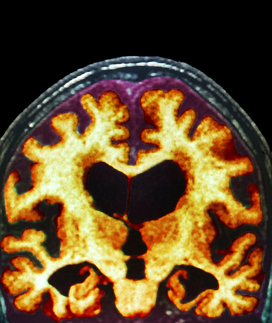 Alzheimer's disease brain,MRI scan