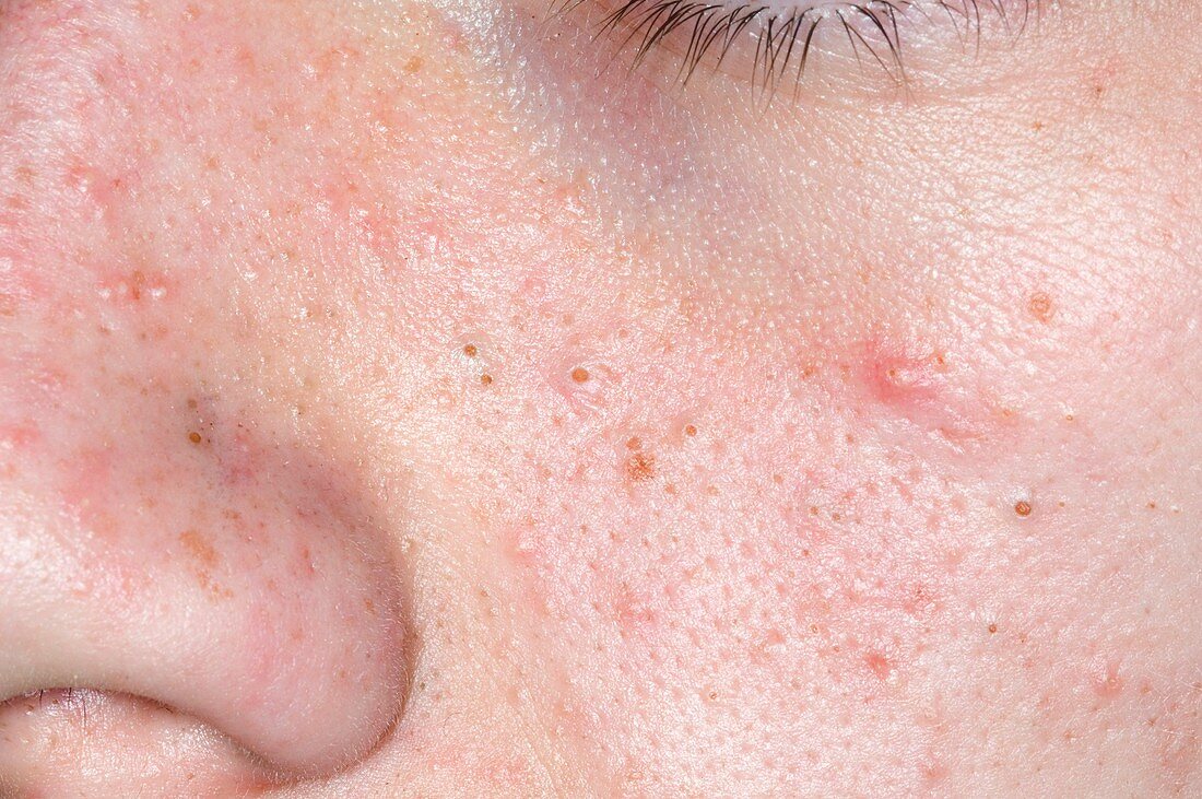 Acne vulgaris on the face