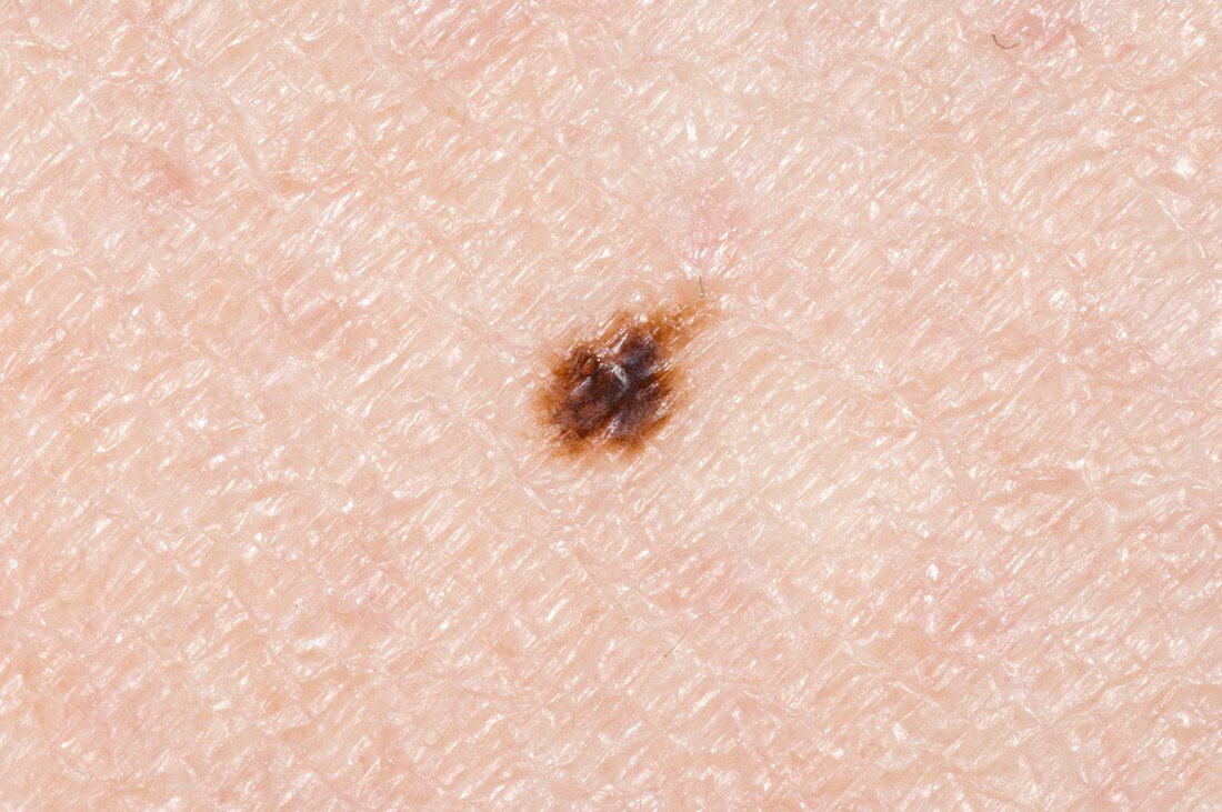Mole (naevus) on the skin