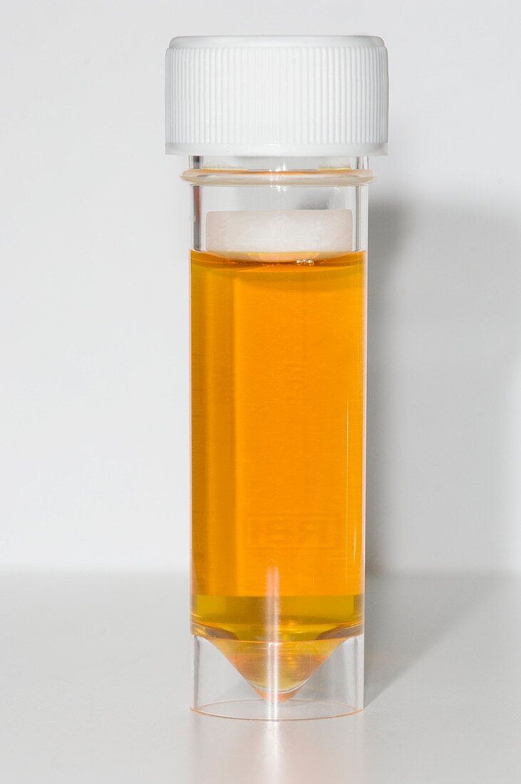 Dark urine in patient with jaundice