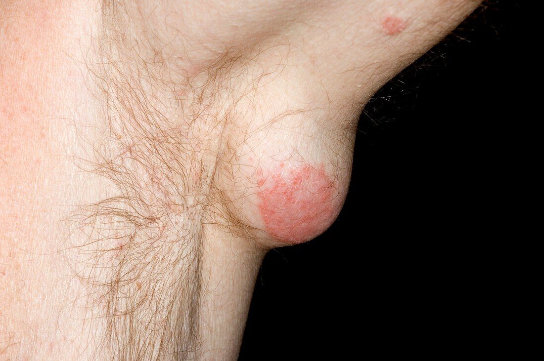 Epidermal cyst under the arm