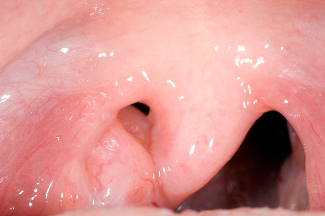 Asymmetric healthy tonsils