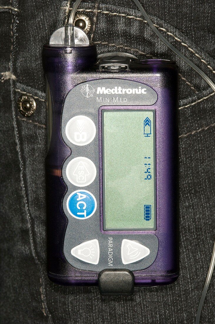Insulin pump in diabetes