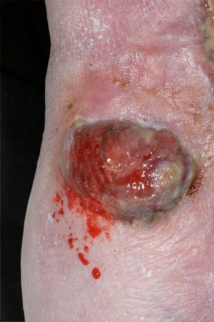Skin cancer (melanoma) on the foot