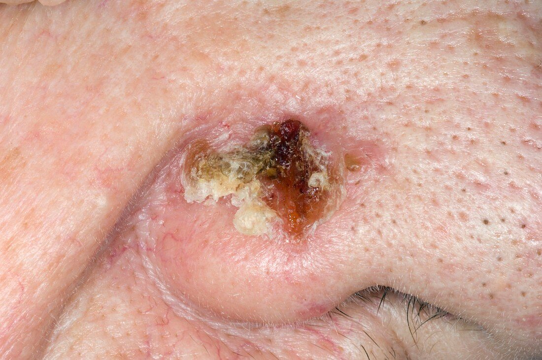 Skin cancer on the nose
