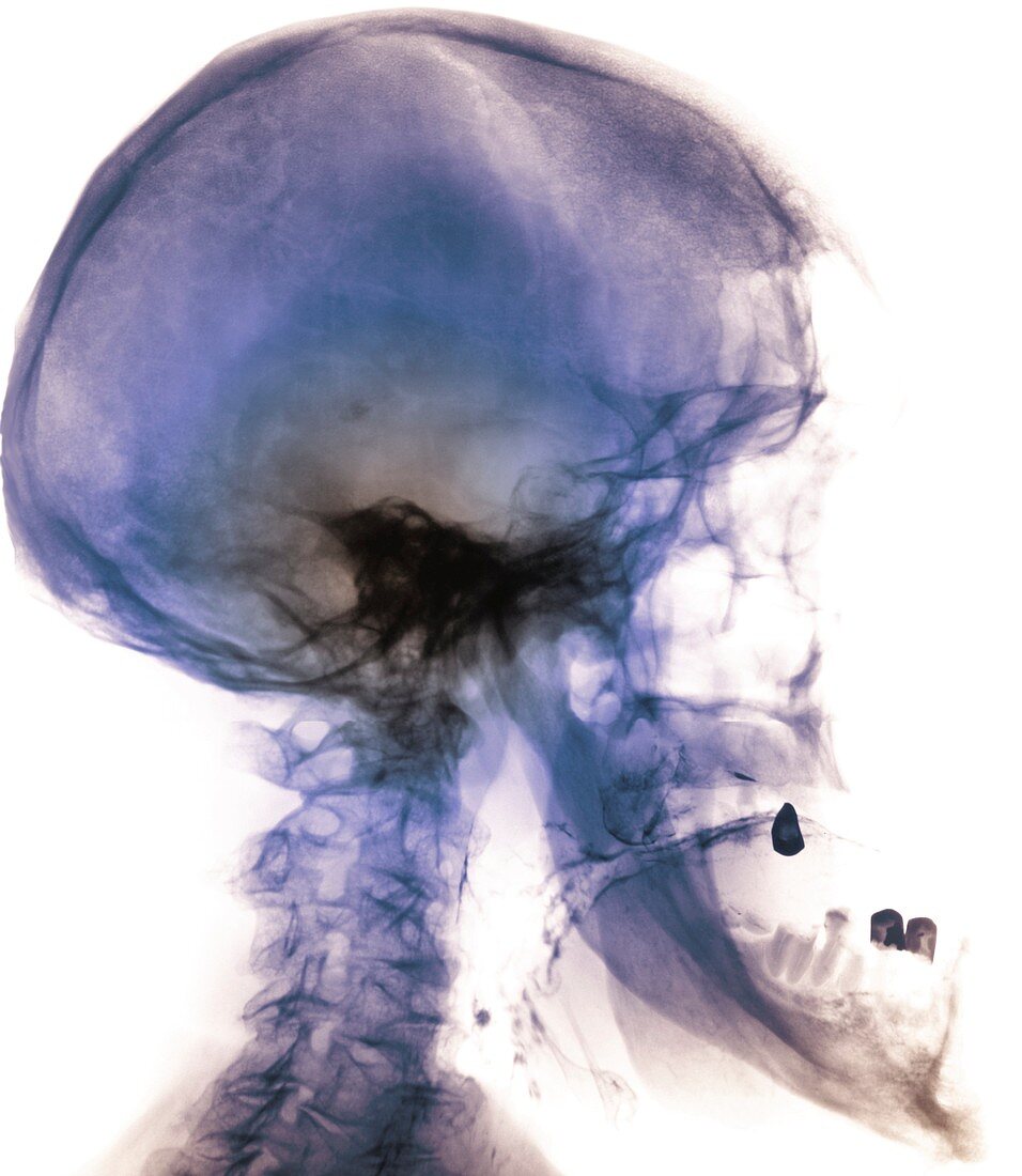 Acromegaly of the skull,X-ray