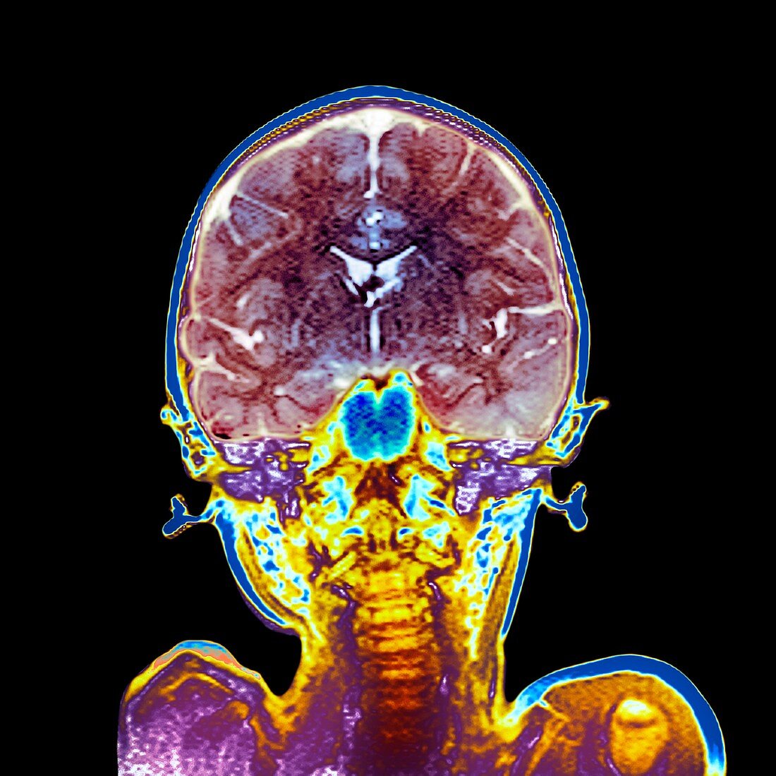 Child's brain,MRI scan