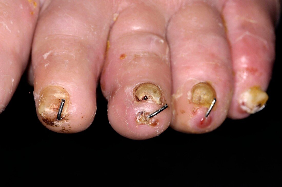 Surgical treatment of bunion