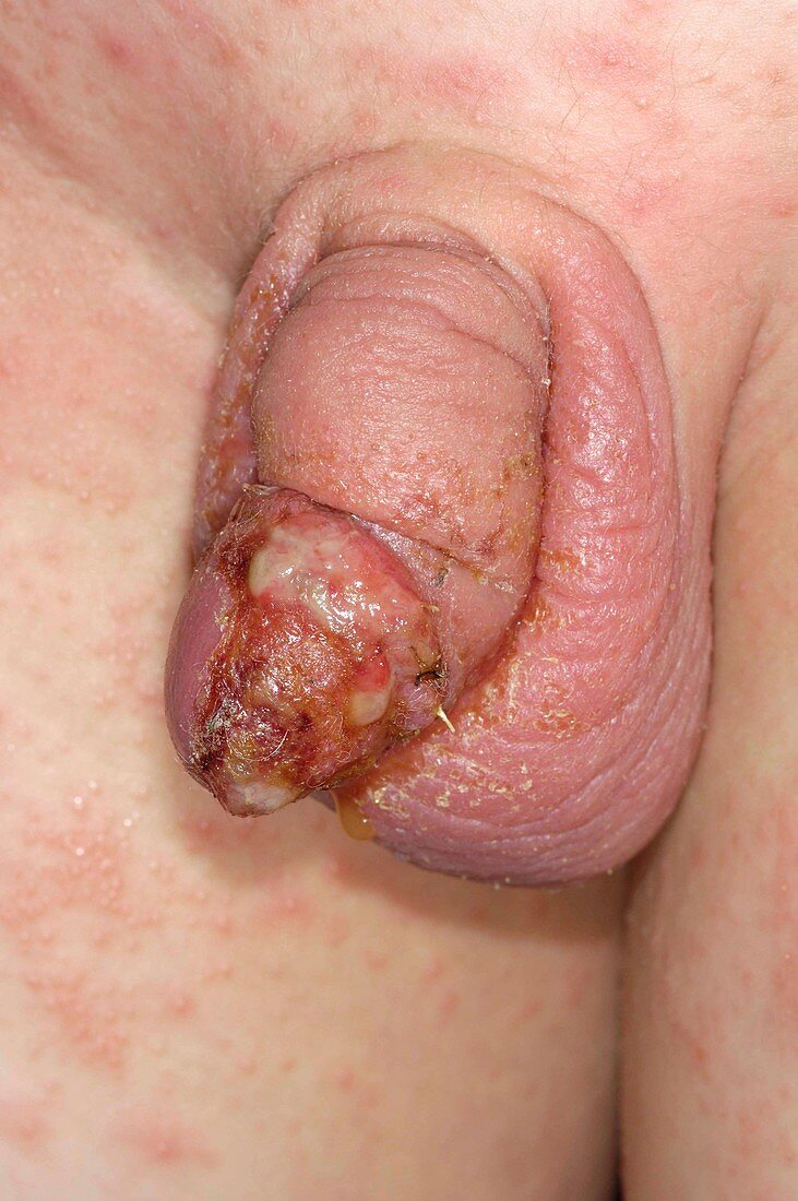 Infected circumcision wound