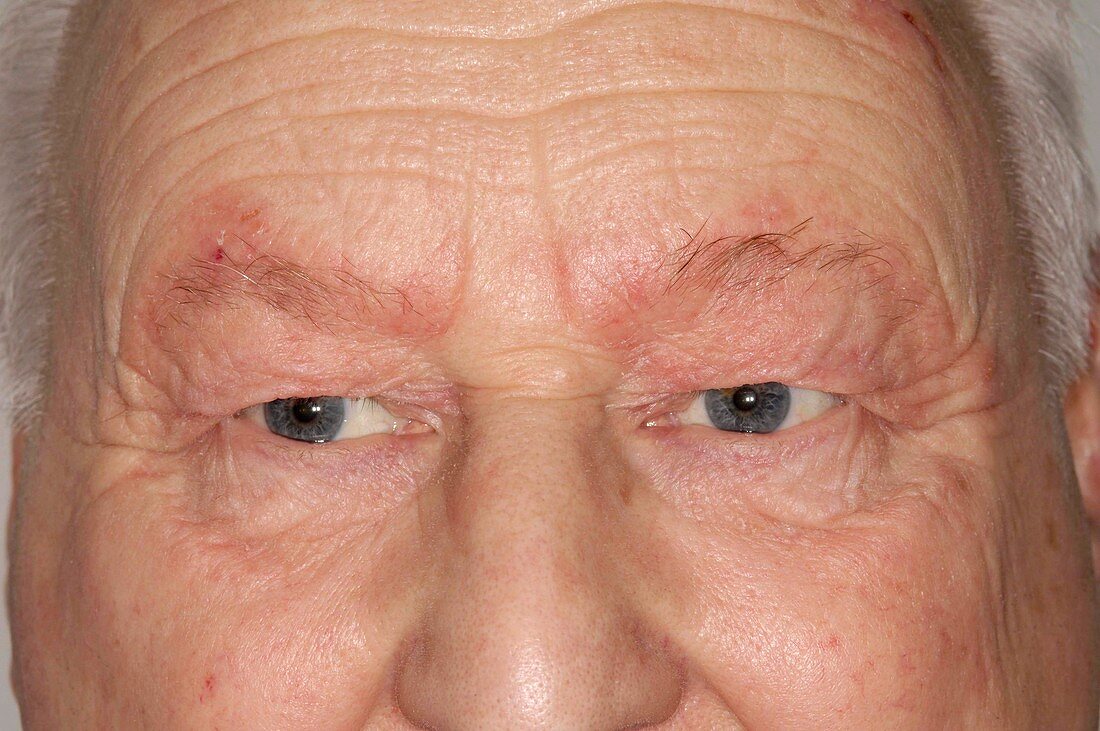 Seborrhoeic dermatitis around eyes