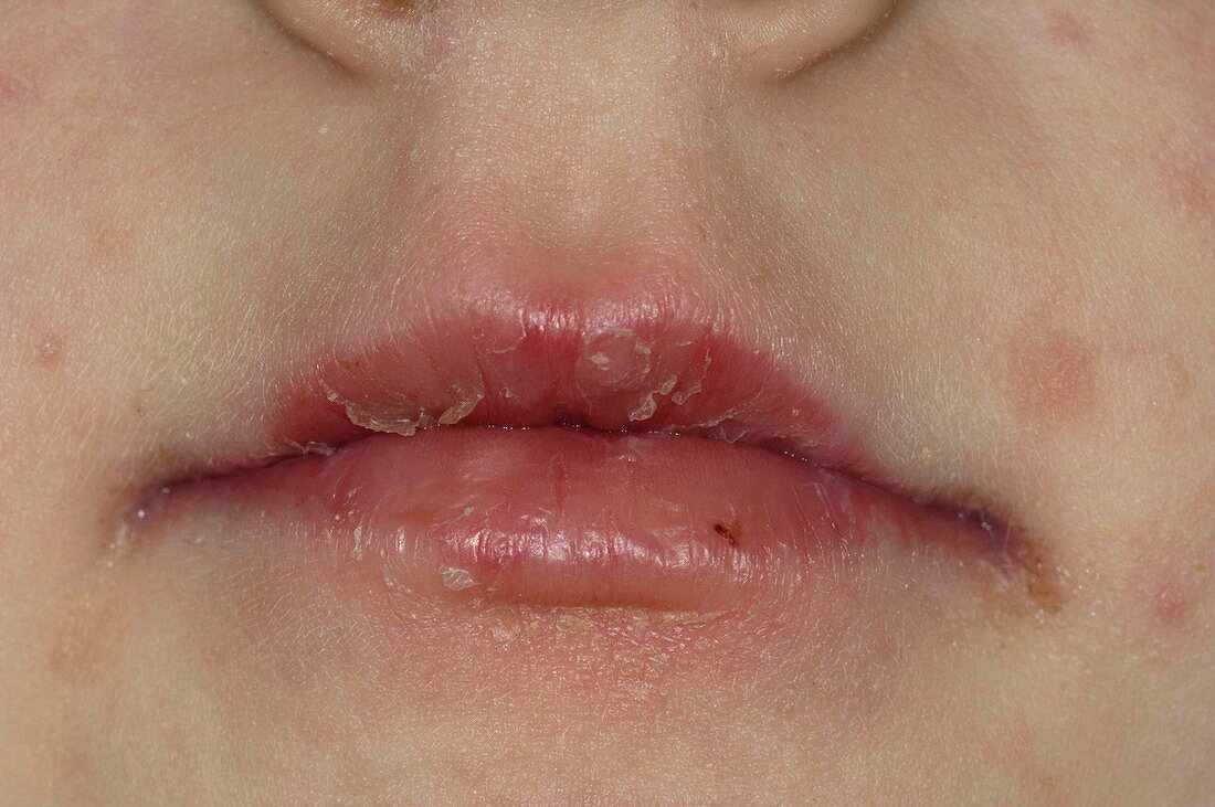 Cracked peeling lips after viral infectio