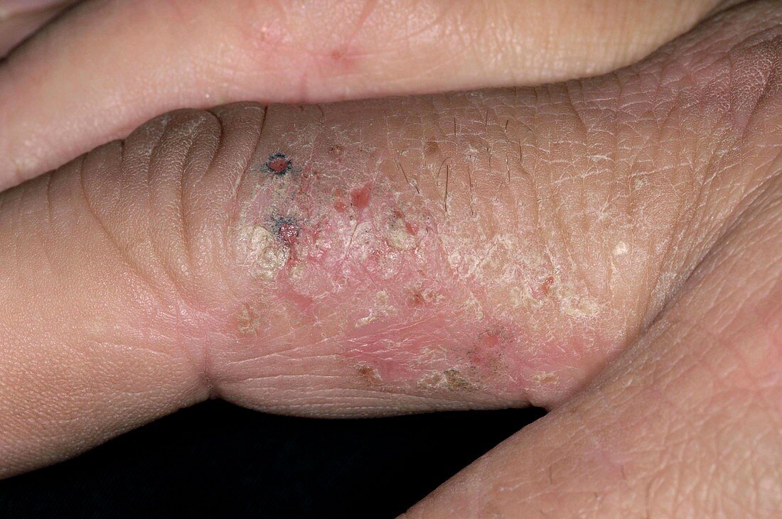 Contact dermatitis on the fingers