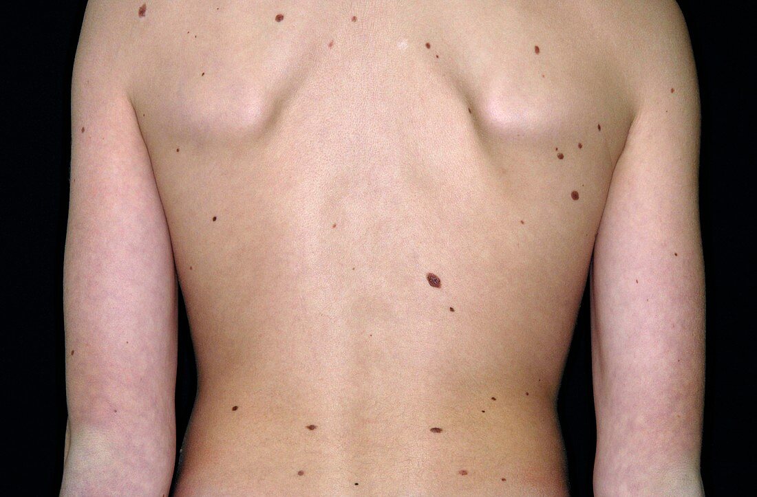 Moles on the skin of the torso