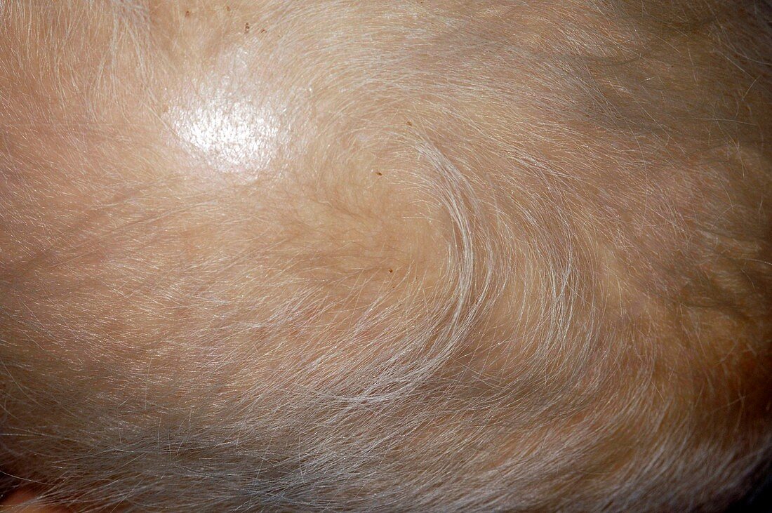 Fine hair in ectodermal dysplasia