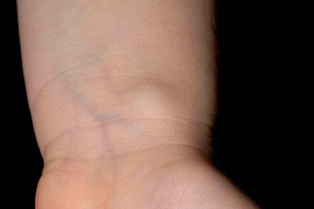 Ganglion on the wrist of a child