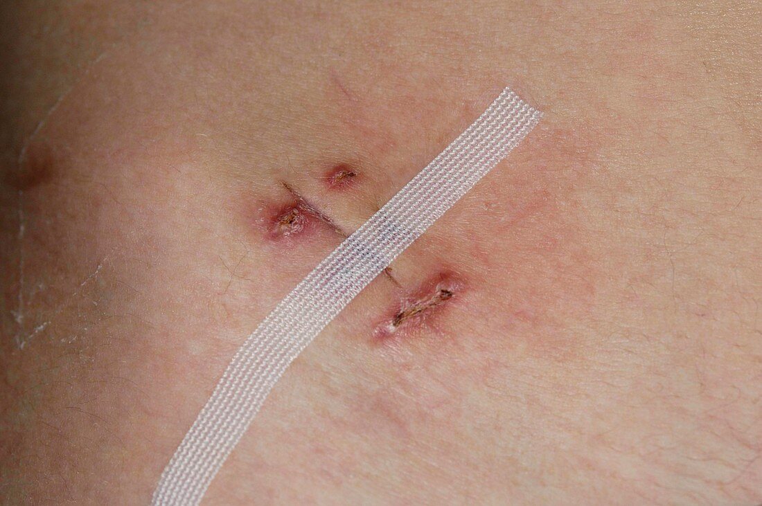 Infected appendectomy wound