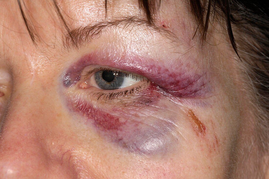 Black eye after a fall