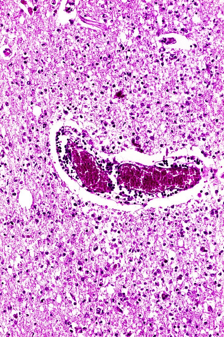 Herpes encephalitis,light micrograph