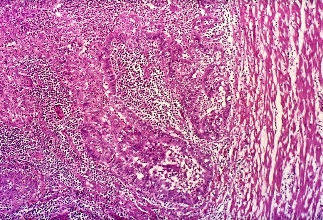 Tubal ectopic pregnancy,light micrograph
