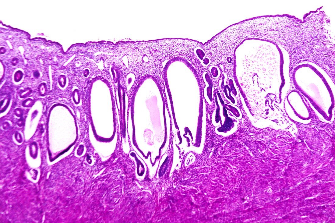Endometrial hyperplasia,light micrograph