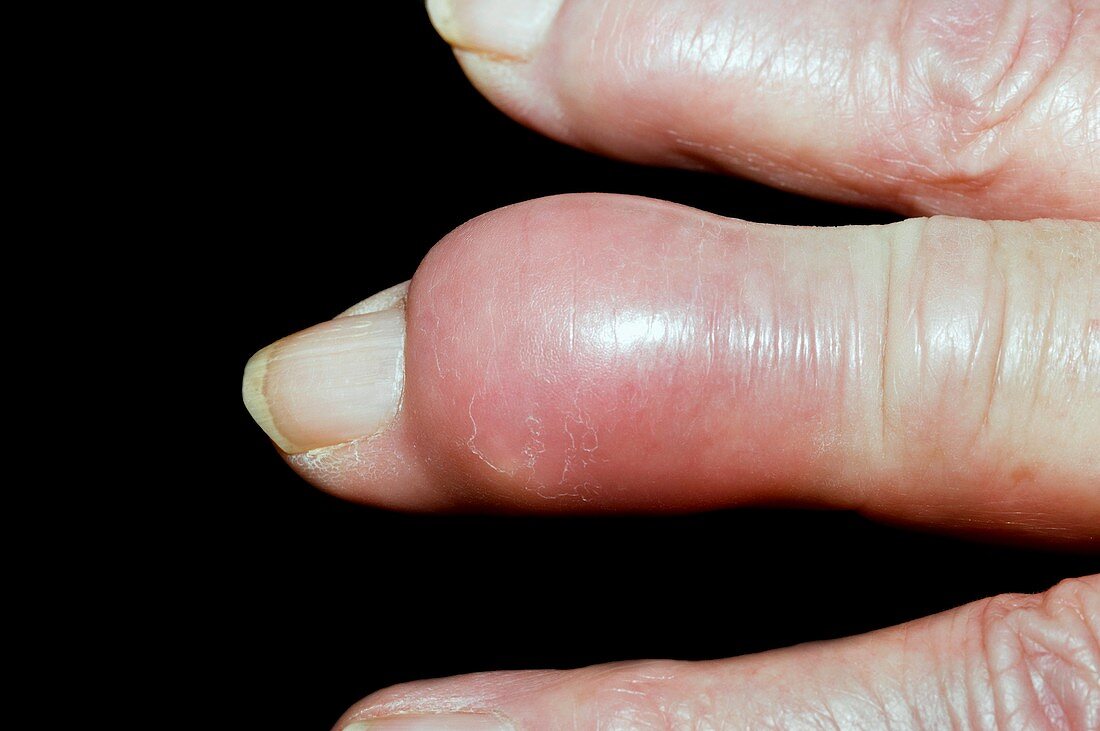 Gout tophus on the finger