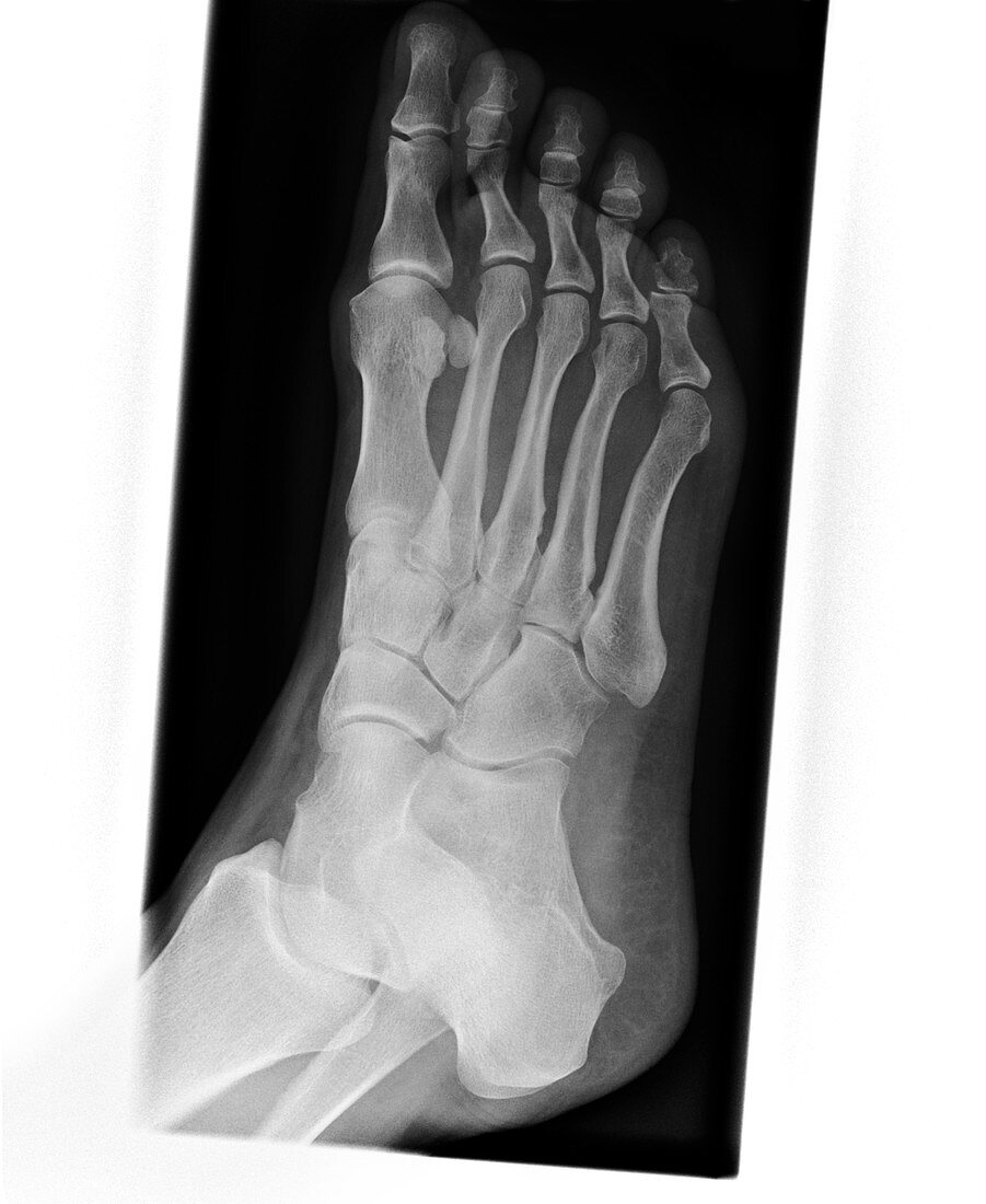 Stress fracture of foot (image 2 of 4)