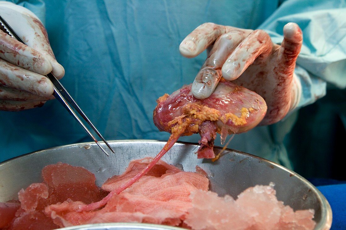 Paediatric living kidney transplant
