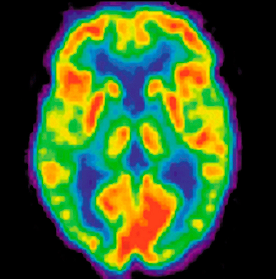 PET scan of a normal brain