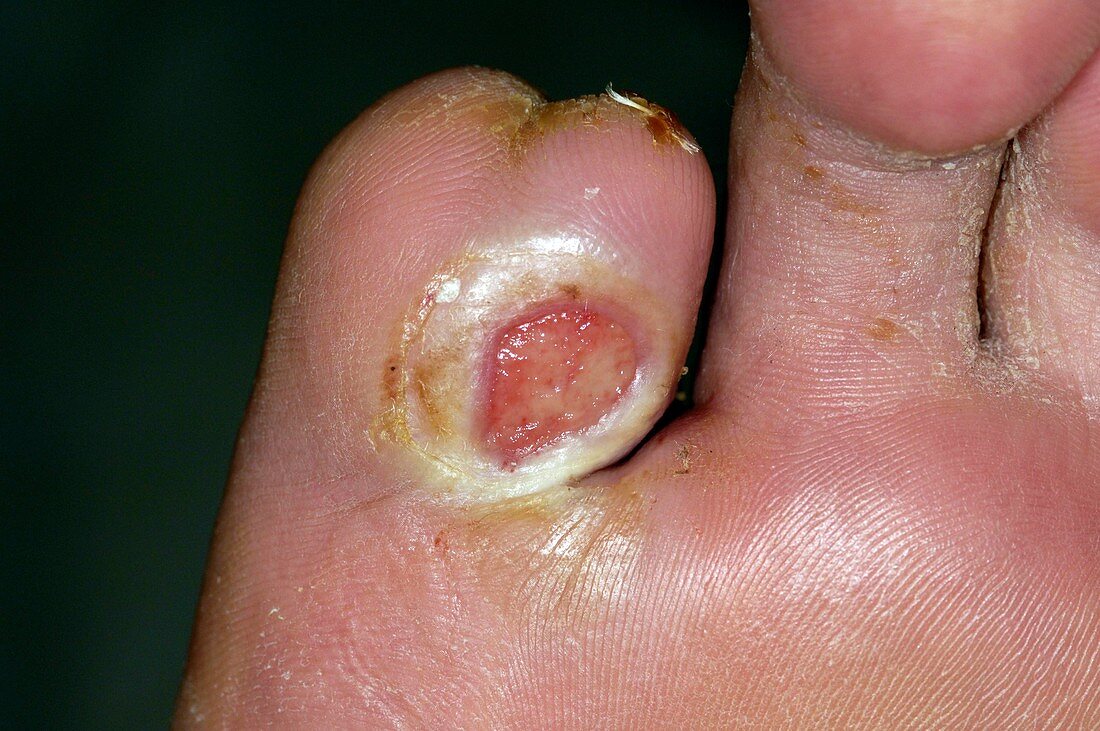 Blister under amputated diabetic toe