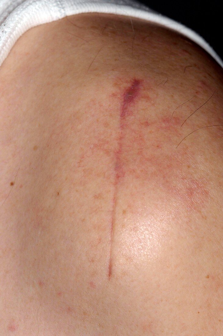 Scar from shoulder decompression