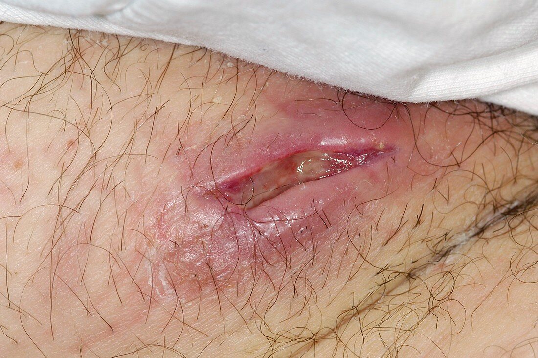 Perineal abscess