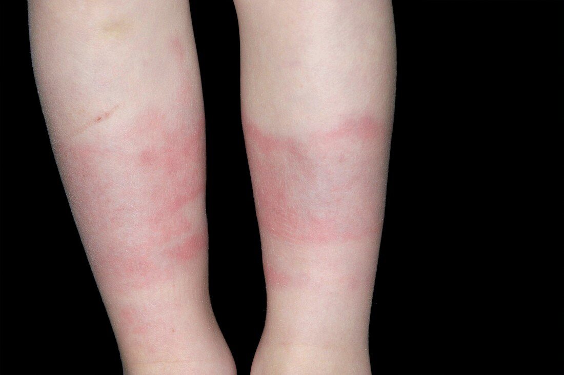 Urticaria caused by the cold
