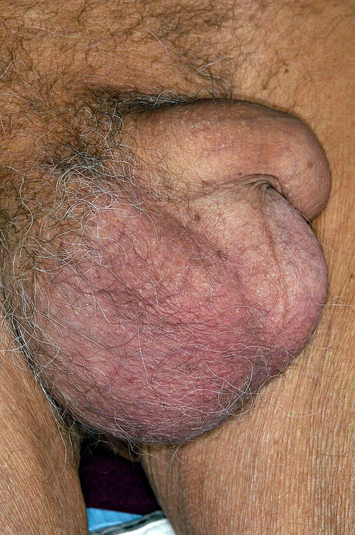 Epididymal cyst causing swollen scrotum