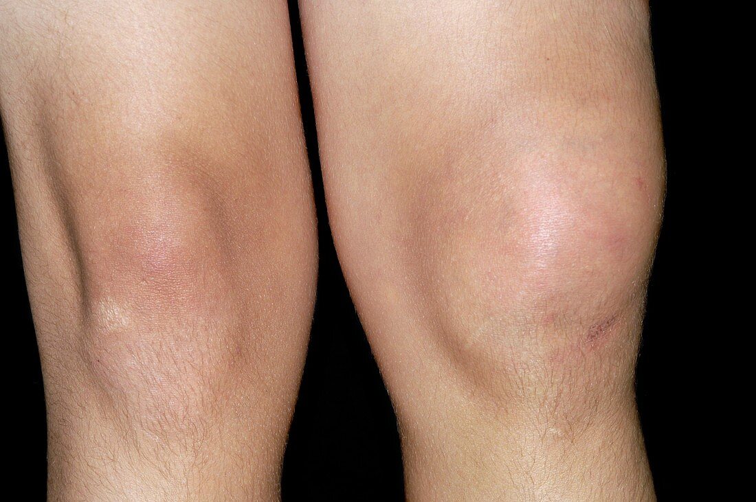 Torn thigh muscle in football injury