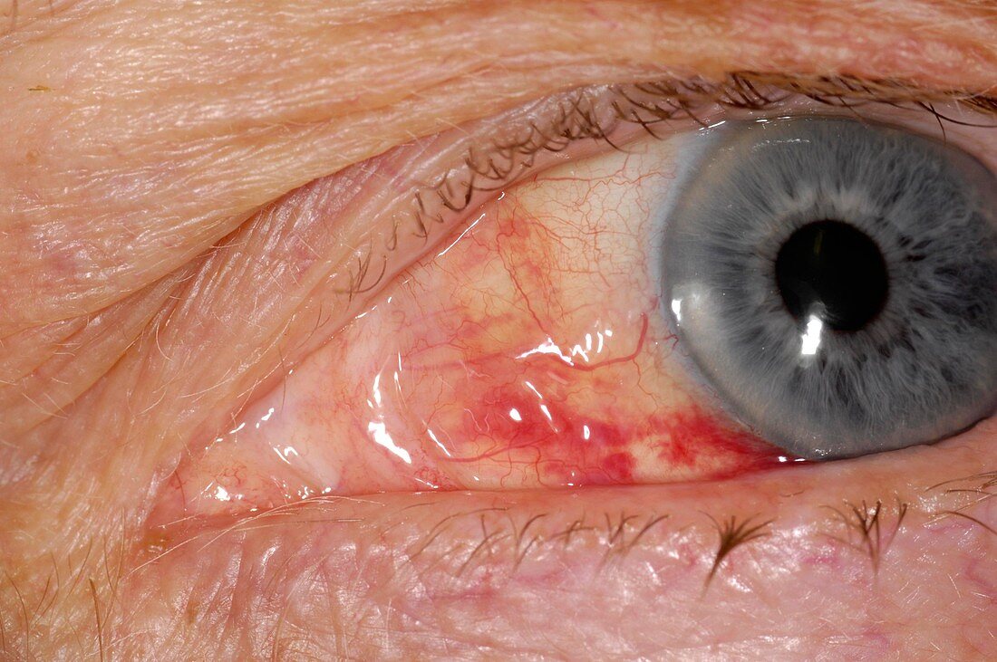 Choroidal neovascularisation of eye